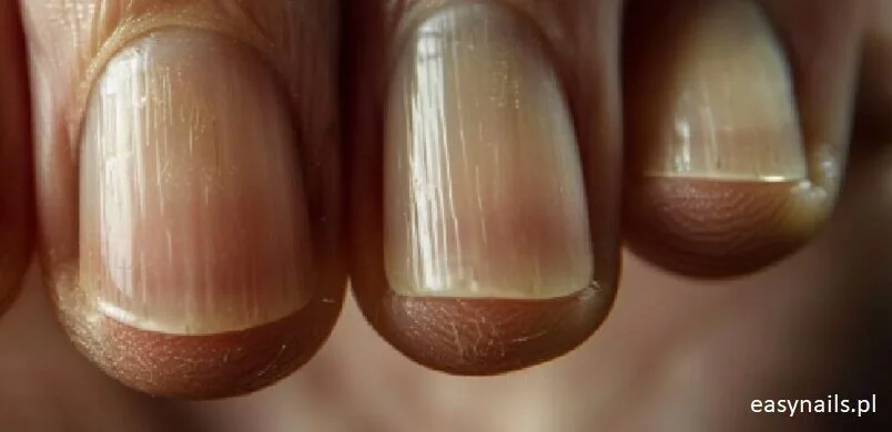 Karbowane Paznokcie: Przyczyny I&nbsp;Sposoby Na&nbsp;Ich Wygładzenie